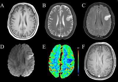 Case report: Autoimmune encephalitis associated with anti-CASPR2 antibody mimicking cerebral infarction